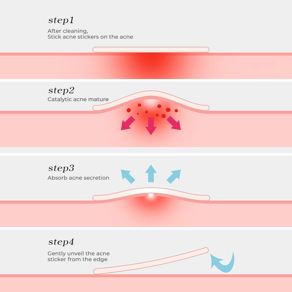 Pimple Patch for Covering Zits and Blemishes 200 Patchs Round-shaped / Star-shaped
