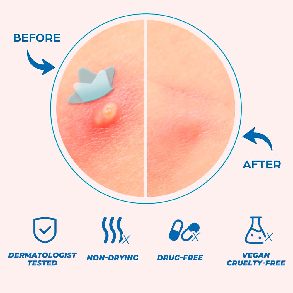 Pimple Patch for Covering Zits and Blemishes 200 Patchs Round-shaped / Star-shaped